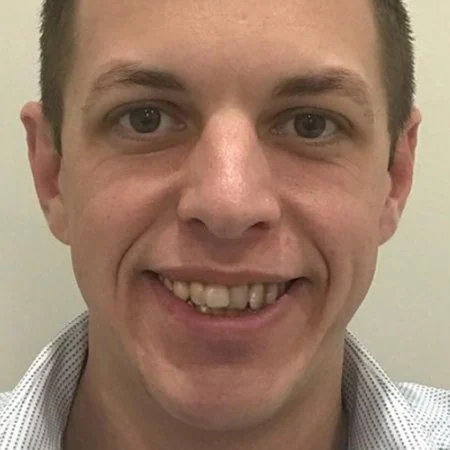 Homem antes do tratamento Invisalign, com dentes desalinhados — paciente em São José dos Campos